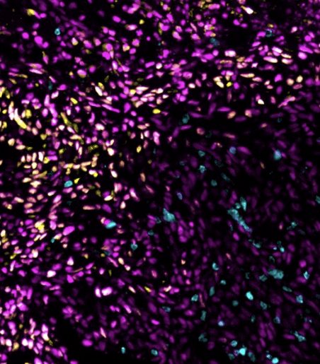 layered image illustrates why immunotherapy alone may not be enough to treat triple-negative breast cancer