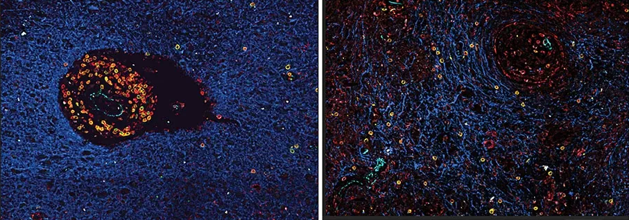 paired image shows how combining radiation therapy with immunotherapy can help mobilize the immune system against glioblastoma, an aggressive brain cancer.