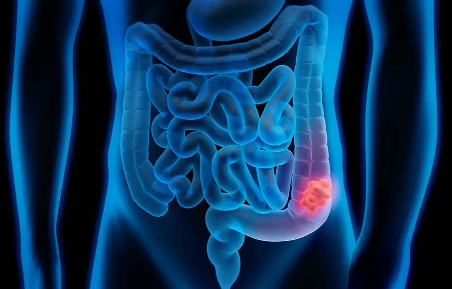 Inflammation in colon