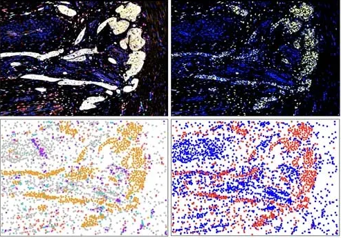 tumor microenvironment of pancreatic cancer