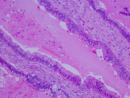 Pancreatic cancer cells