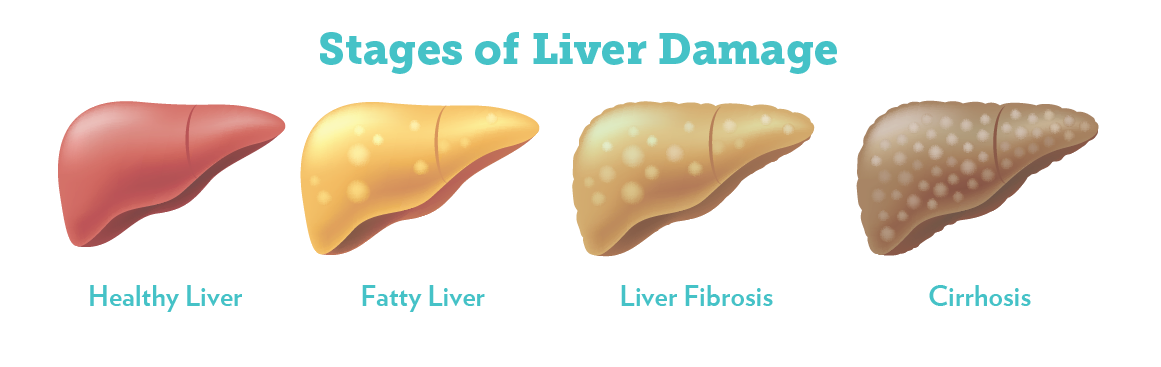 stages-liver-disease