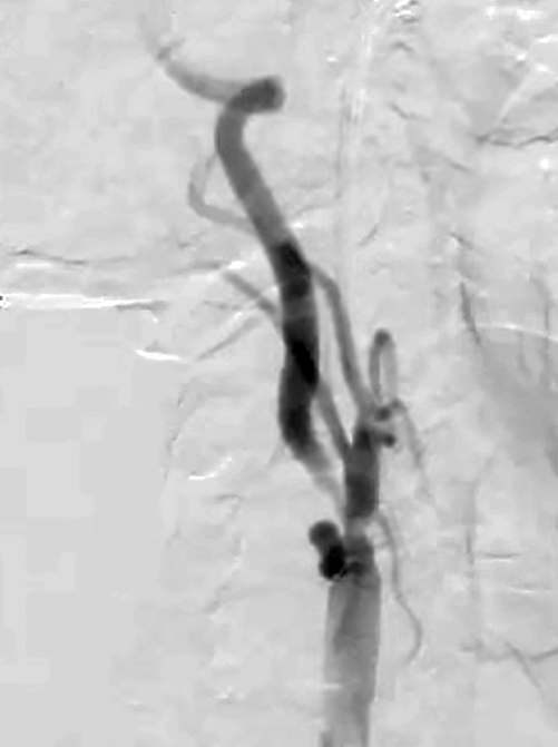 Figure 1: Stenosis in the right internal carotid artery.