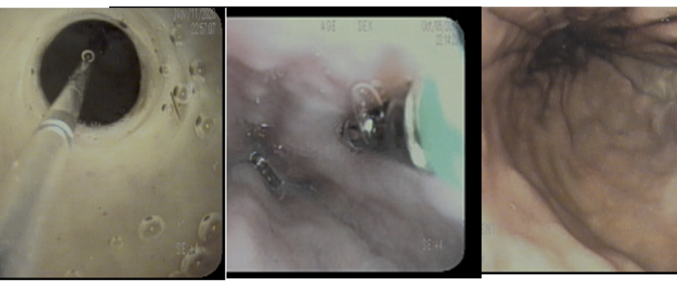 transnasal esophagoscopy