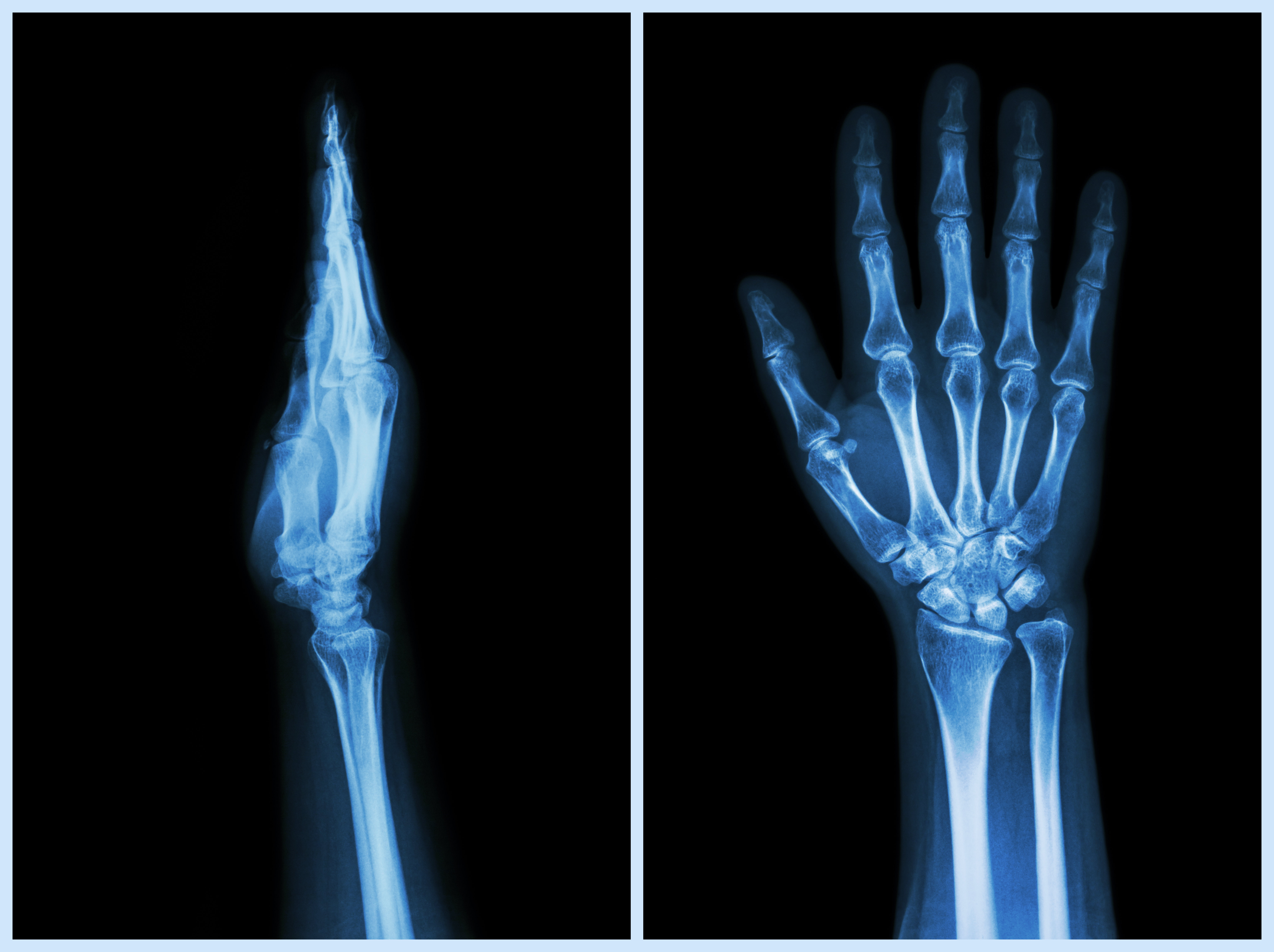 Hip Fracture  Cedars-Sinai