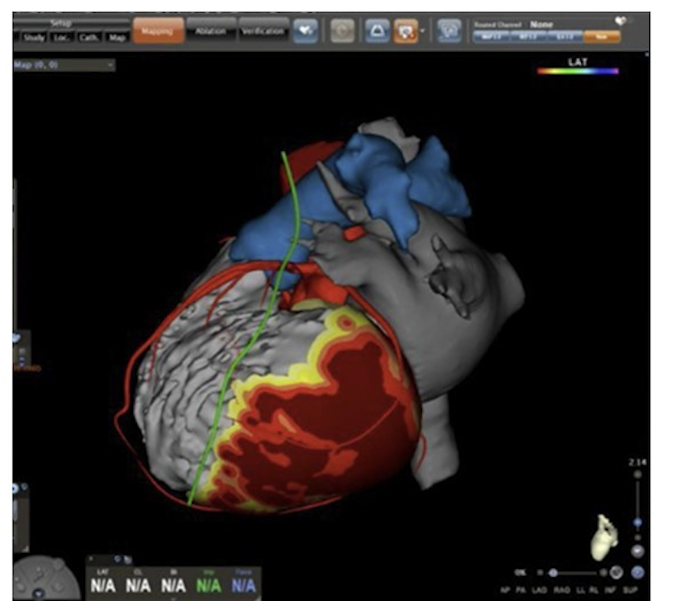 Beyond ICD Shocks and Drugs: Modern Approaches to Ventricular Tachycardia Ablation